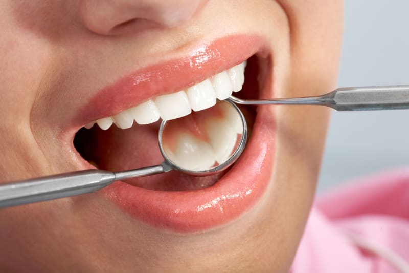 Signature Smiles|Dental Fillings