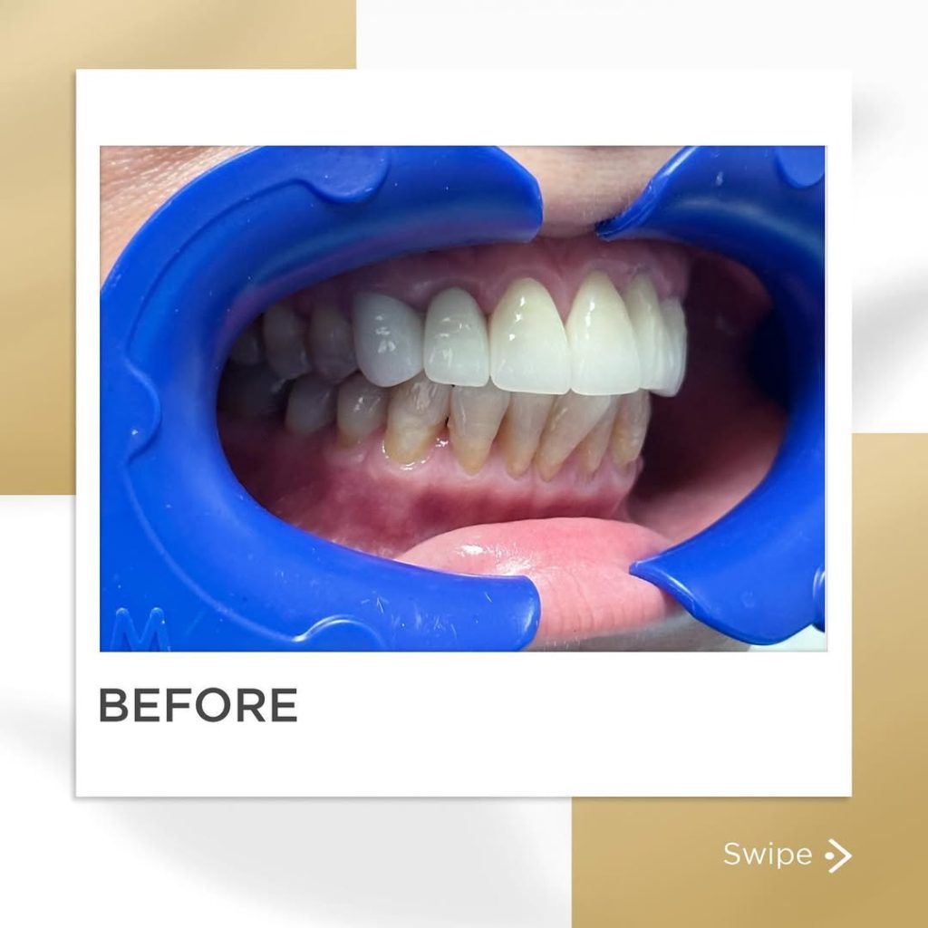 Signature Smiles|BEFORE / AFTERS
