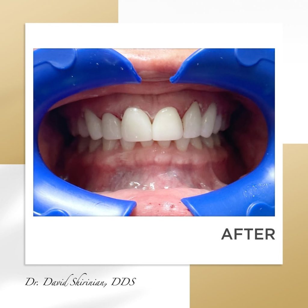 Signature Smiles|BEFORE / AFTERS