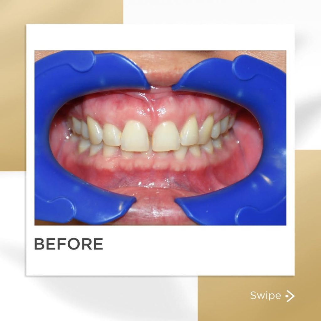 Signature Smiles|BEFORE / AFTERS