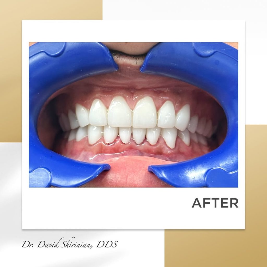 Signature Smiles|BEFORE / AFTERS