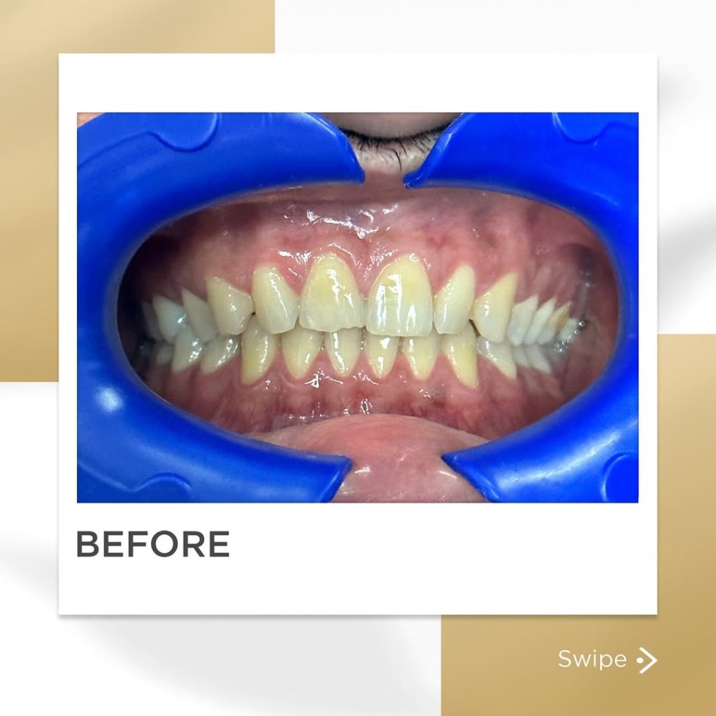 Signature Smiles|BEFORE / AFTERS