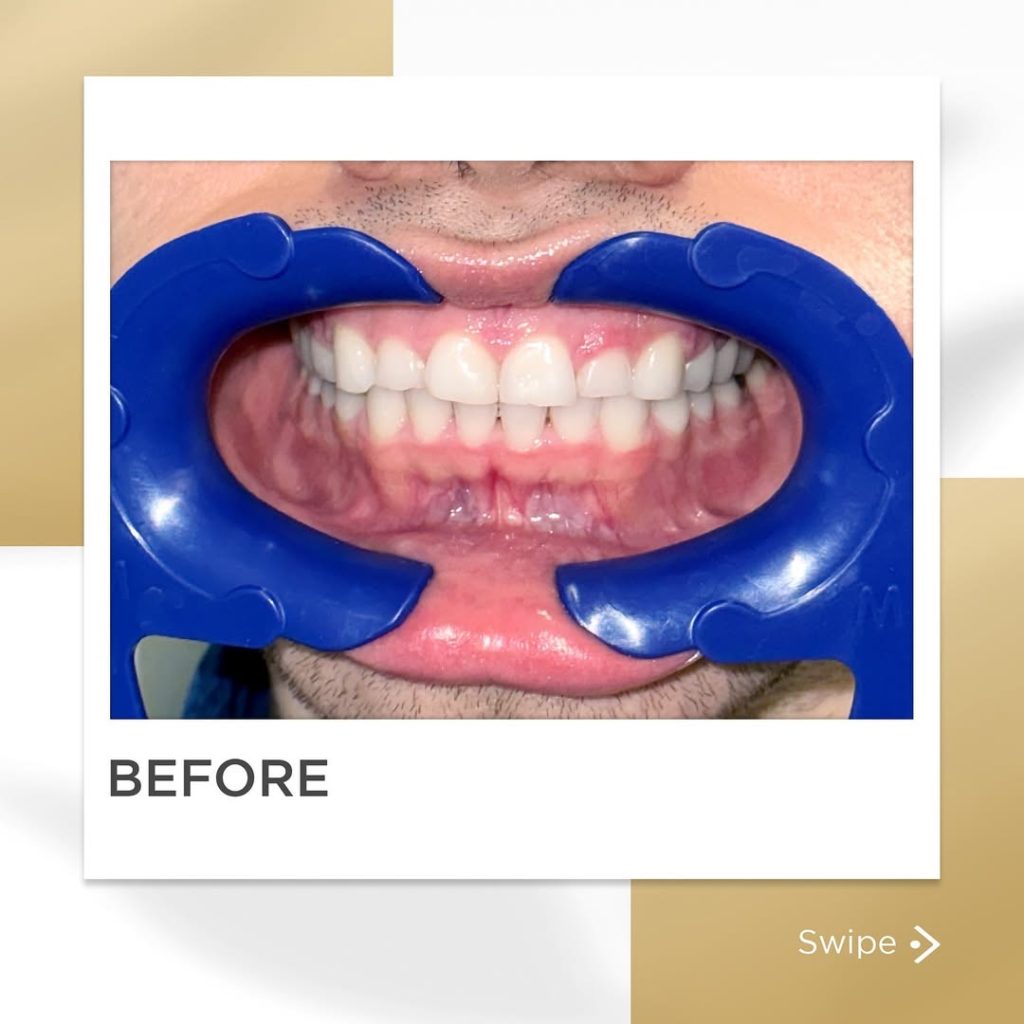 Signature Smiles|BEFORE / AFTERS