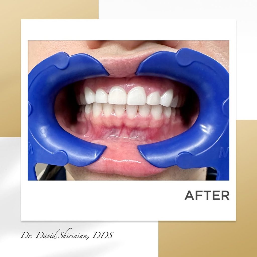 Signature Smiles|BEFORE / AFTERS