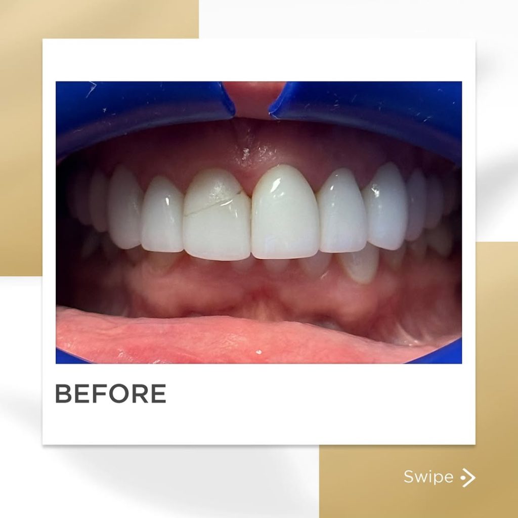 Signature Smiles|BEFORE / AFTERS