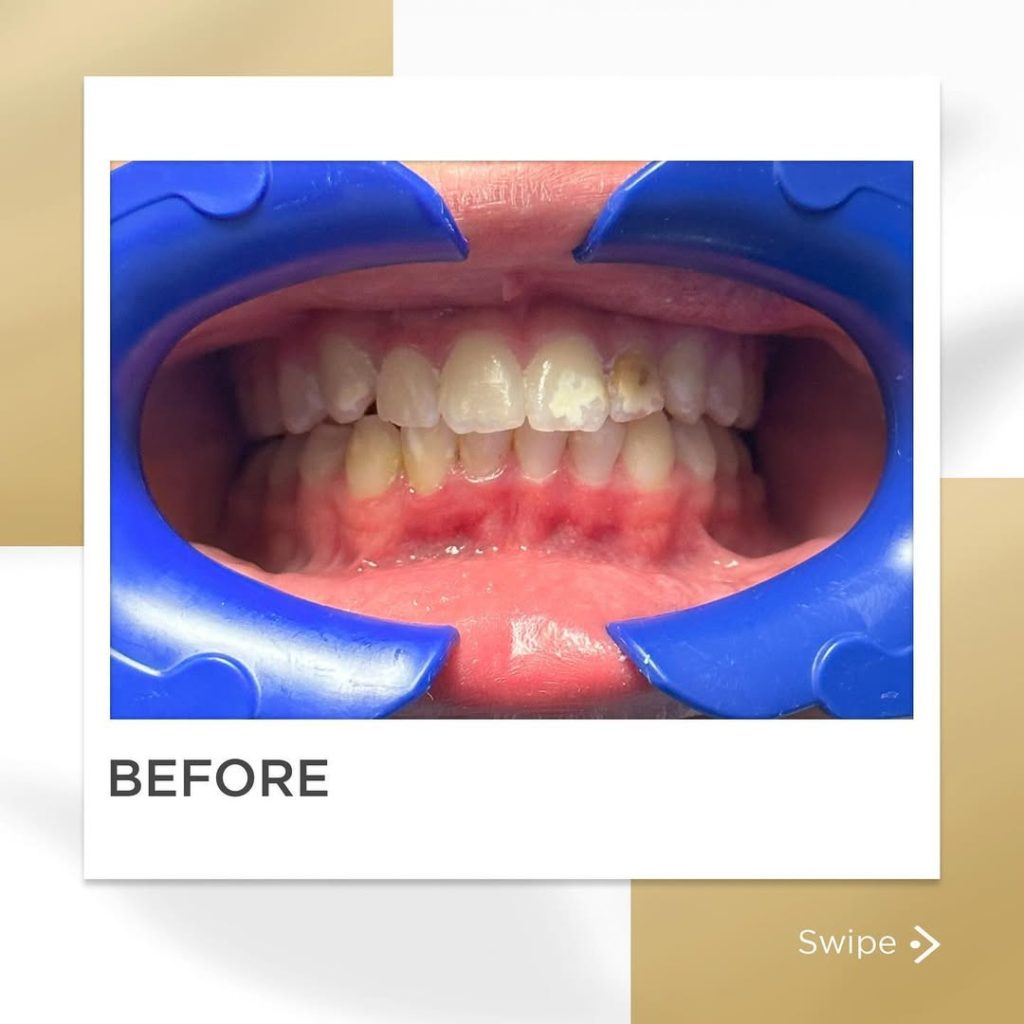 Signature Smiles|BEFORE / AFTERS