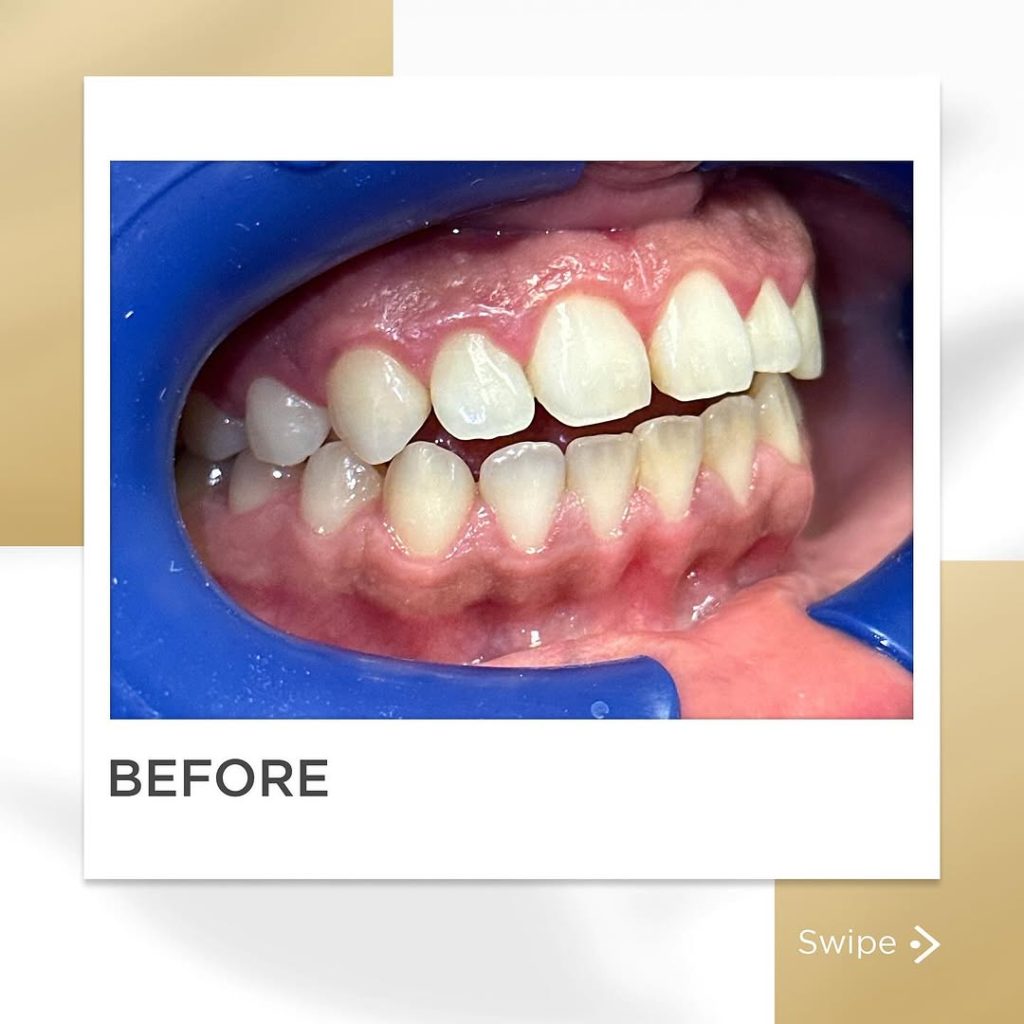 Signature Smiles|BEFORE / AFTERS