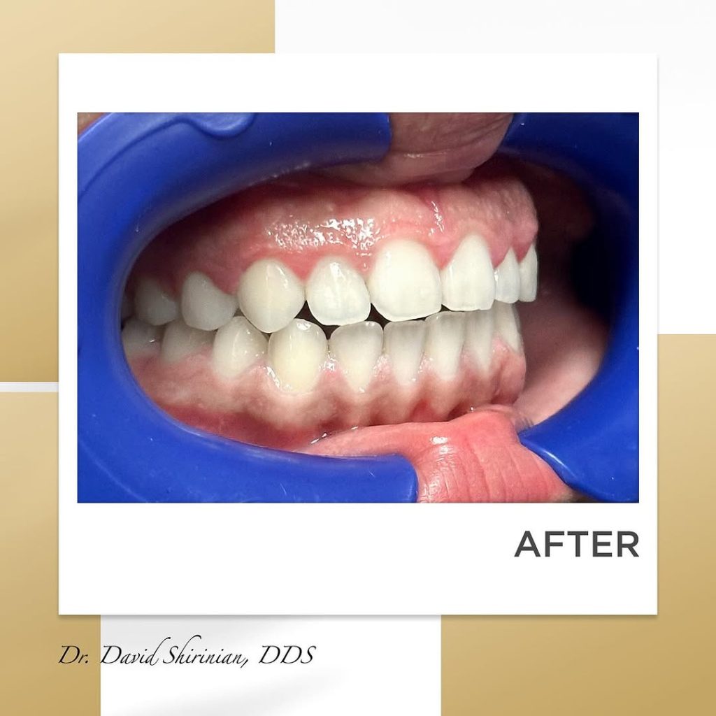 Signature Smiles|BEFORE / AFTERS