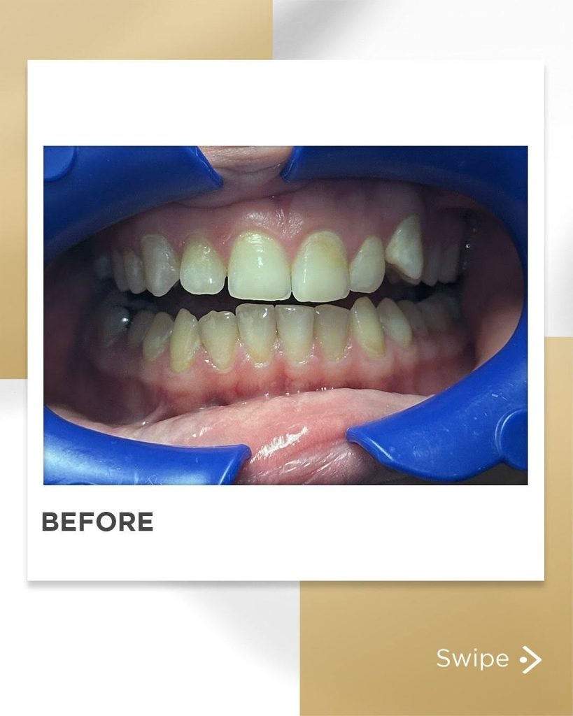 Signature Smiles|BEFORE / AFTERS