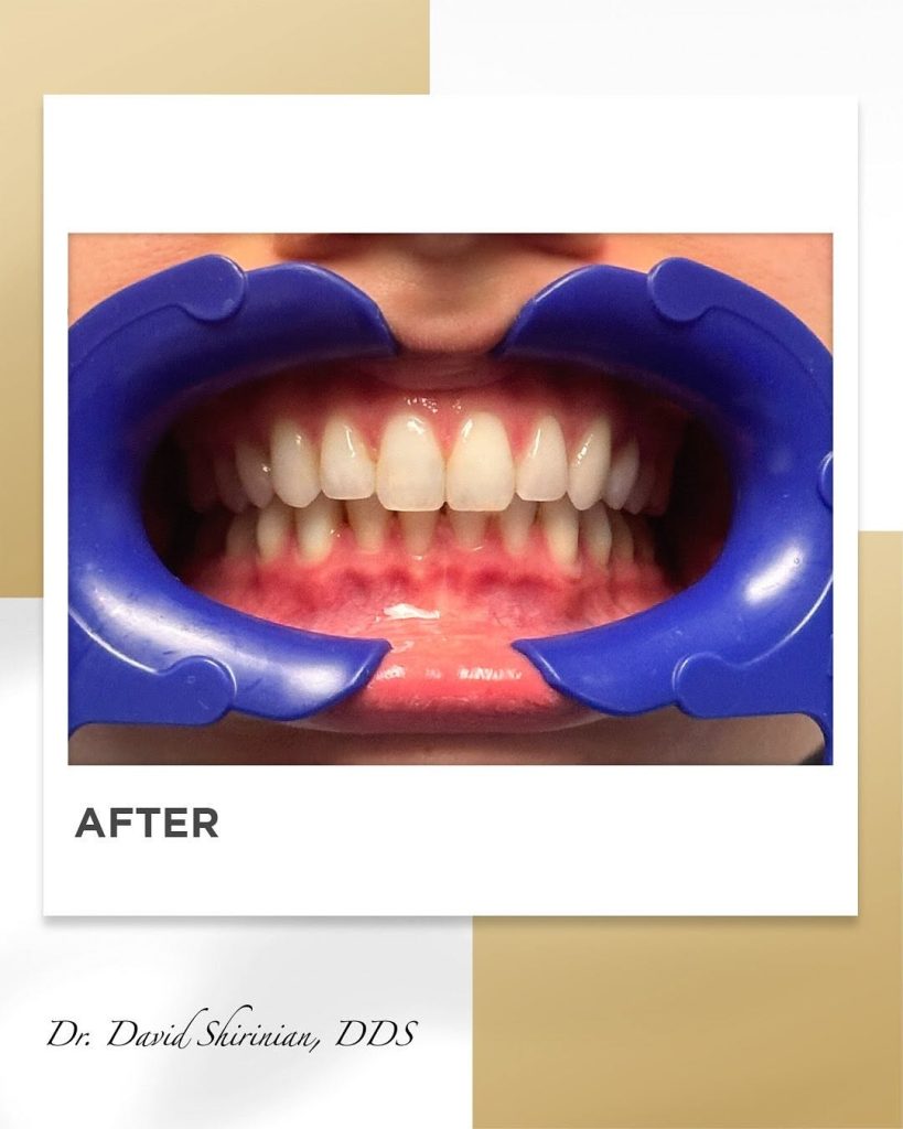 Signature Smiles|BEFORE / AFTERS