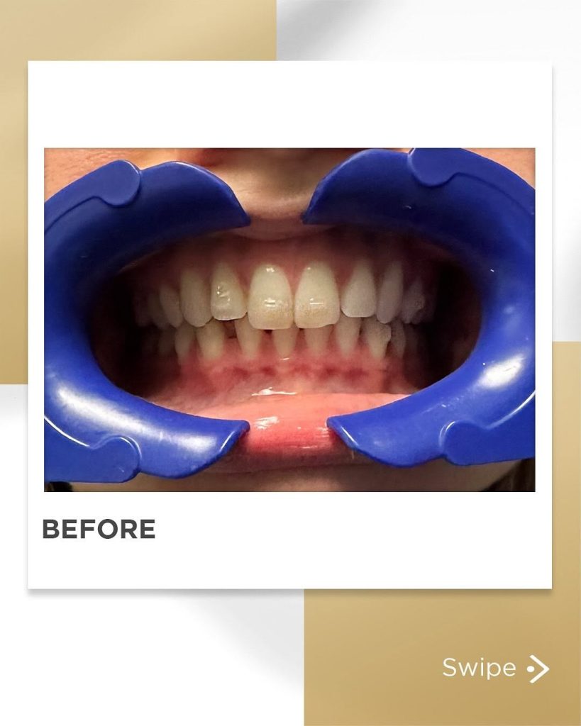 Signature Smiles|BEFORE / AFTERS