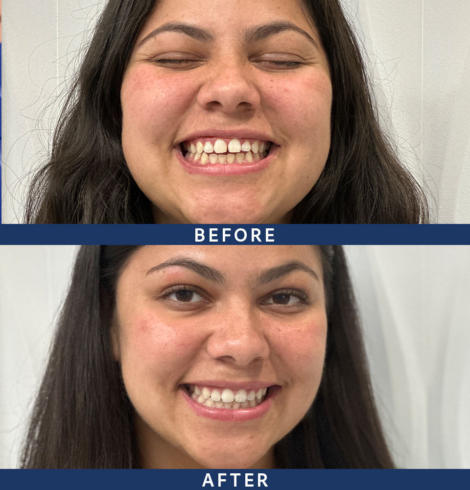 invisalign before after