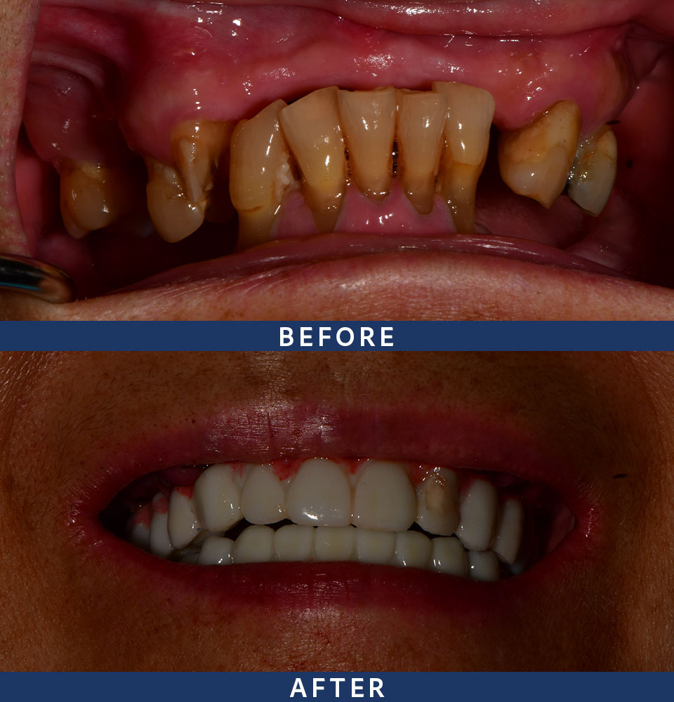 implants before-after