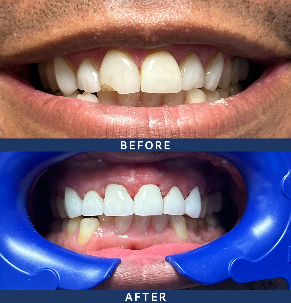 before-after