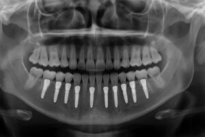 A panoramic x-ray of a patient's mouth in Cleveland, OH, clearly showing several dental implants integrated into the jawbone, supporting a full set of teeth. No text on image.