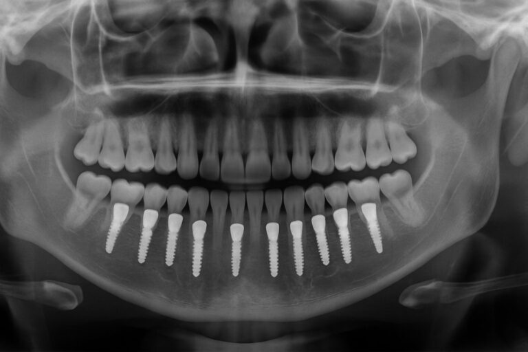 A panoramic x-ray of a patient's mouth in Cleveland, OH, clearly showing several dental implants integrated into the jawbone, supporting a full set of teeth. No text on image.