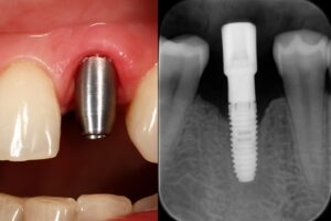 Close-up image of a dental implant in a patient's mouth with the abutment exposed due to gum recession, alongside an X-ray showing bone loss around the implant. No text on image.