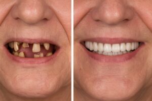 A before-and-after photo showcasing a patient's smile transformation with permanent implant teeth. The "before" side shows missing or damaged teeth, while the "after" side displays a full, natural-looking set of permanent implant teeth. No text on image.